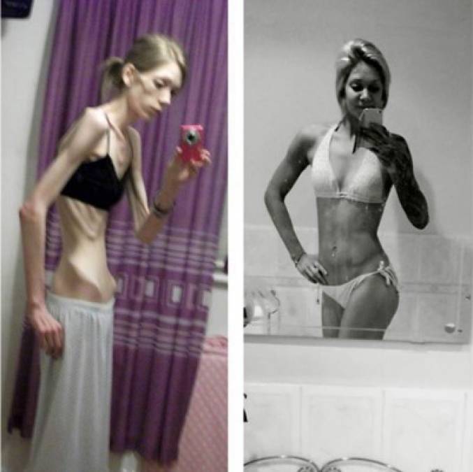 Nicola King Estuvo A Punto De Morir Por Anorexia Y Ahora Es Campeona De